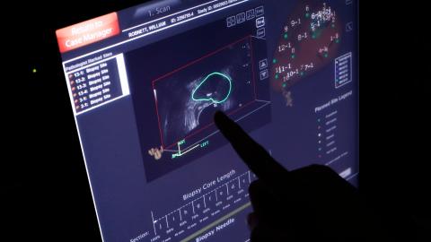 Why Some Doctors Say There Are Cancers That Shouldn't Be Treated