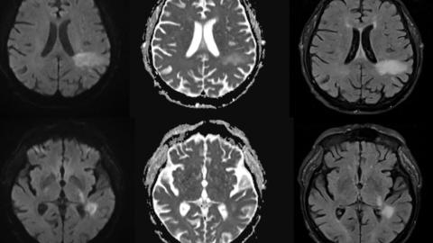 You're likely already infected with a brain-eating virus you've never heard of